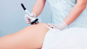 Mesotherapy injections for cellulite