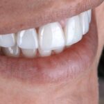 dental veneers in Raleigh