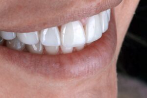 dental veneers in Raleigh