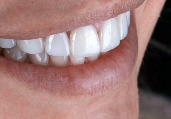 dental veneers in Raleigh